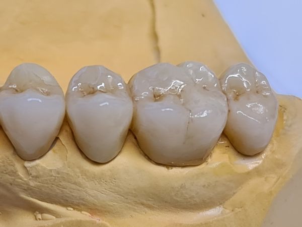Herstellung von Zahnersatz in unserem Praxislabor Zahnarzt Stade