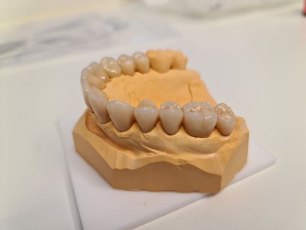 Hochwertiger Zahnersatz aus unserem Praxislabor Zahnarzt Stade bei St Wilhadi