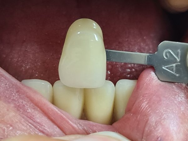 Praxislabor Zahnarzt Stade bei Wilhadi Herstellung von Veneers